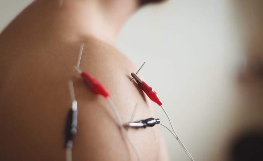 Close-up of patient getting electro dry needling on shoulder